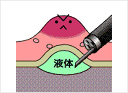 2-局注
粘膜下層に薬剤を注入して浮かせた状態にする