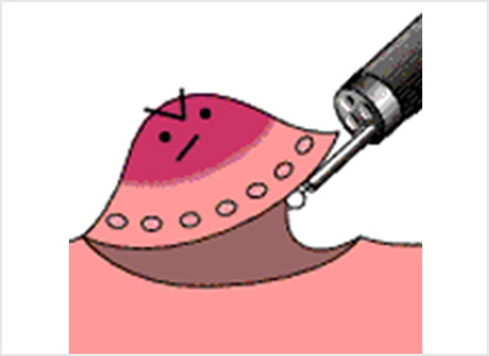 4-粘膜下層のはく離
専用ナイフで病変を少しずつ慎重にはぎ取る