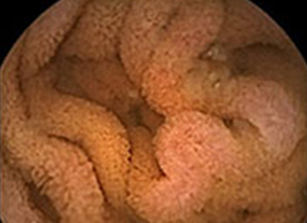 小腸カプセル内視鏡画像