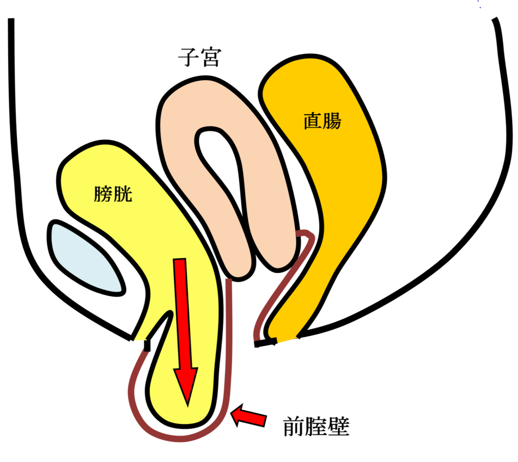 膀胱瘤の女性骨盤臓器位置