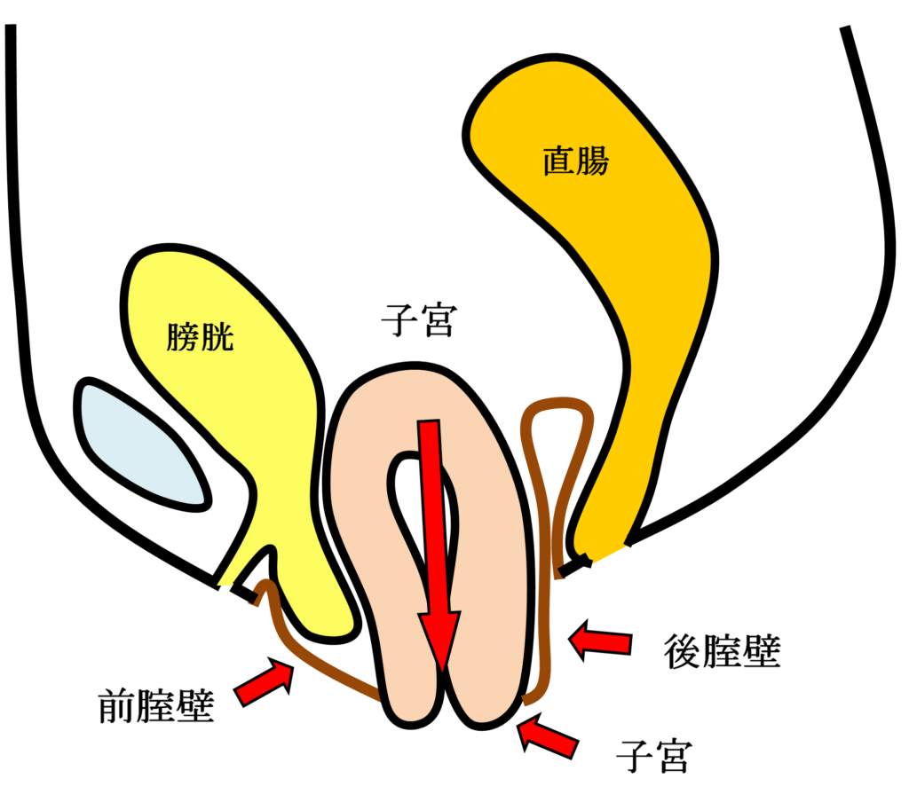 子宮脱の女性骨盤臓器位置