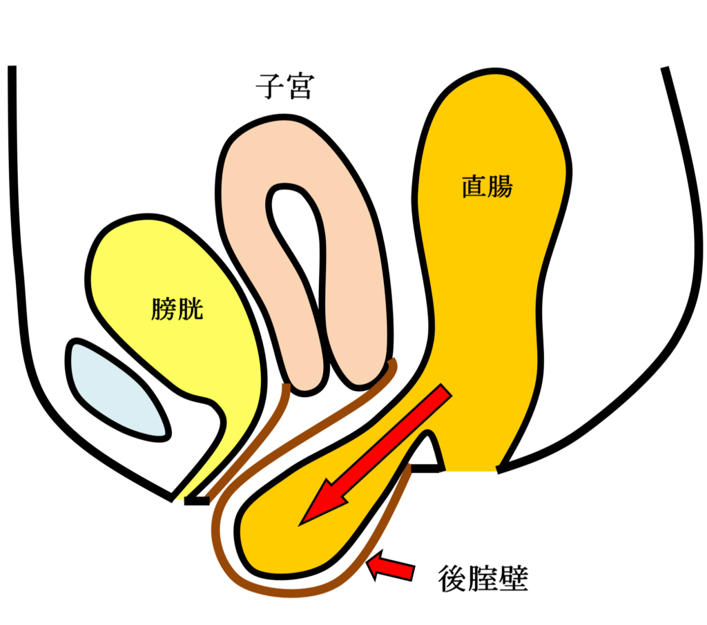 直腸瘤の女性骨盤臓器位置