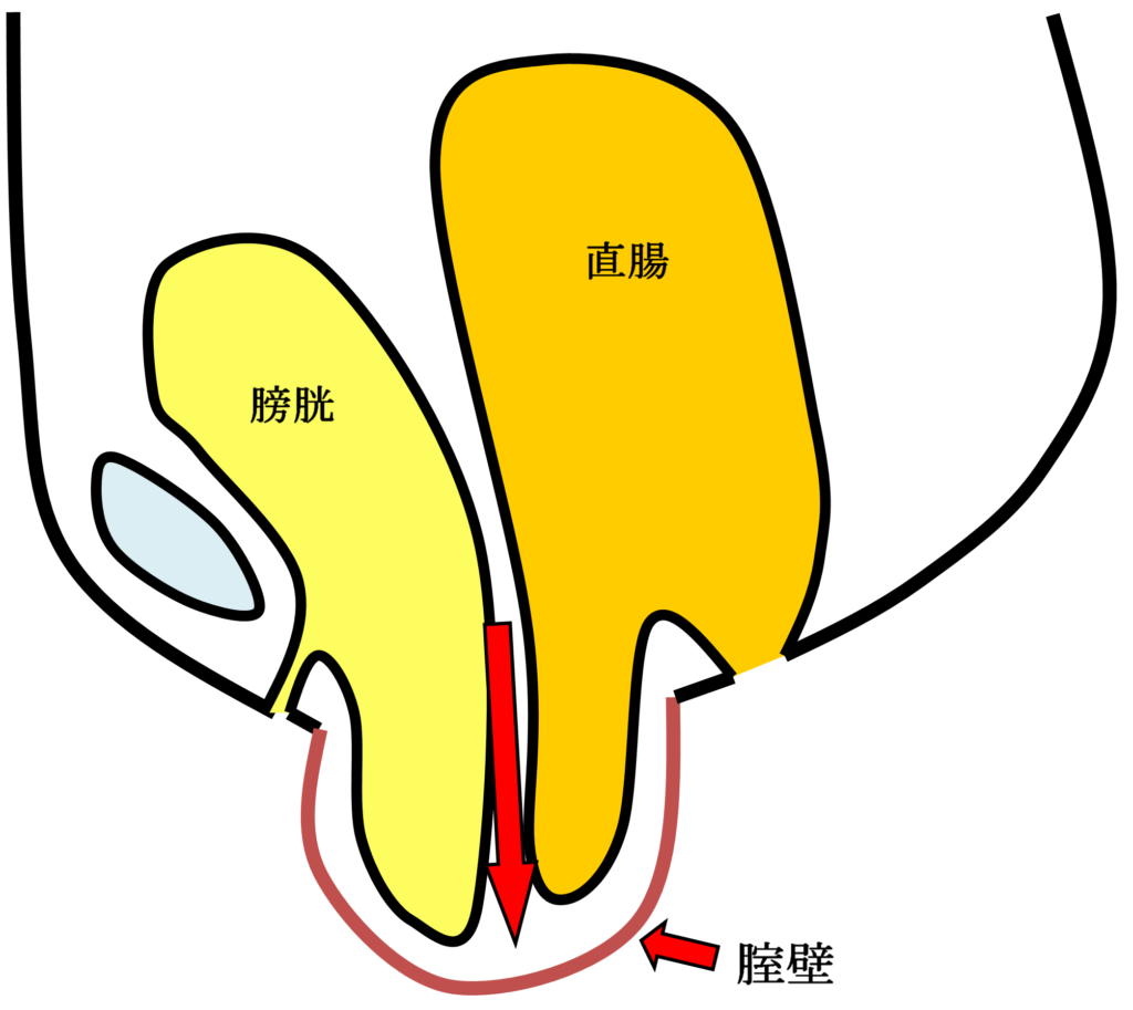 腟断端脱の女性骨盤臓器位置