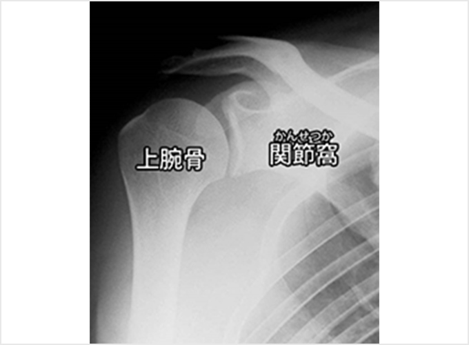 反復性肩関節脱臼（はんぷくせいかたかんせつだっきゅう） | 診療科