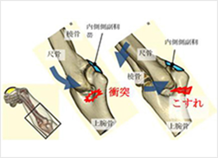 野球肘 やきゅうひじ 診療科 診療センター 名鉄病院