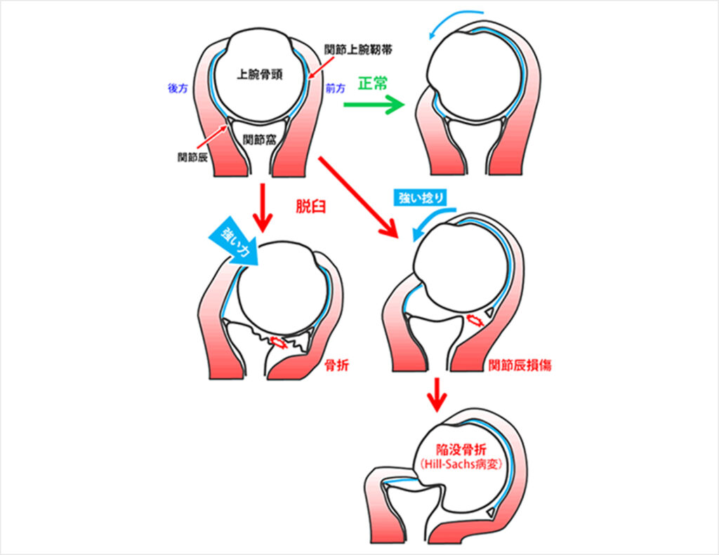 図3.正常と脱臼