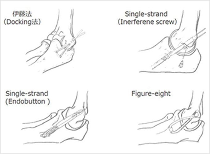 図3b.手首のすじ（腱）を肘に移植して靭帯を再建
