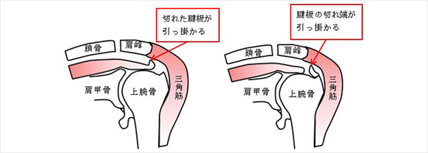 図3b.腱板が切れた状態