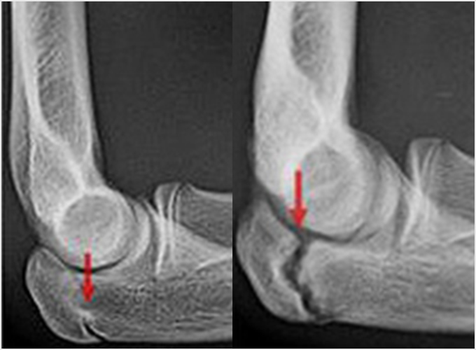 図5b.肘頭骨端線閉鎖不全