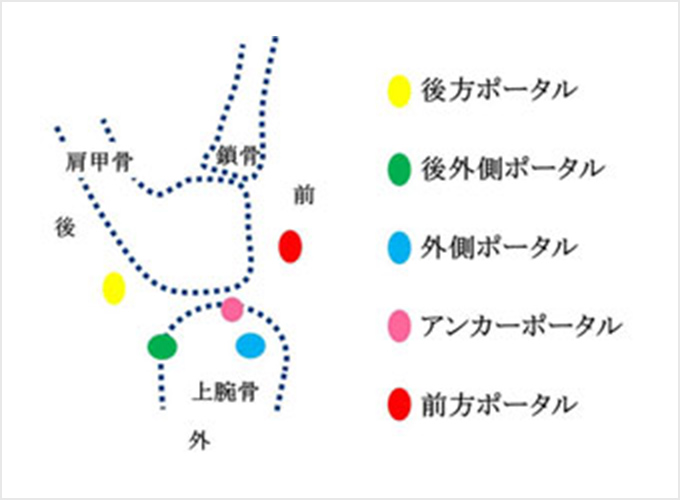 図6. 皮膚切開（ポータルといいます）の位置