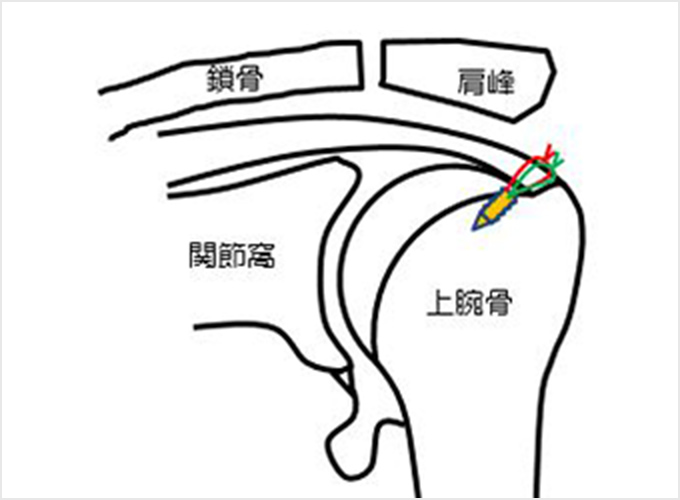 図8.腱板の縫合図　a.通常の縫合