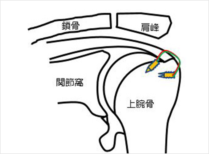 図8.腱板の縫合図　b.ブリッジング法