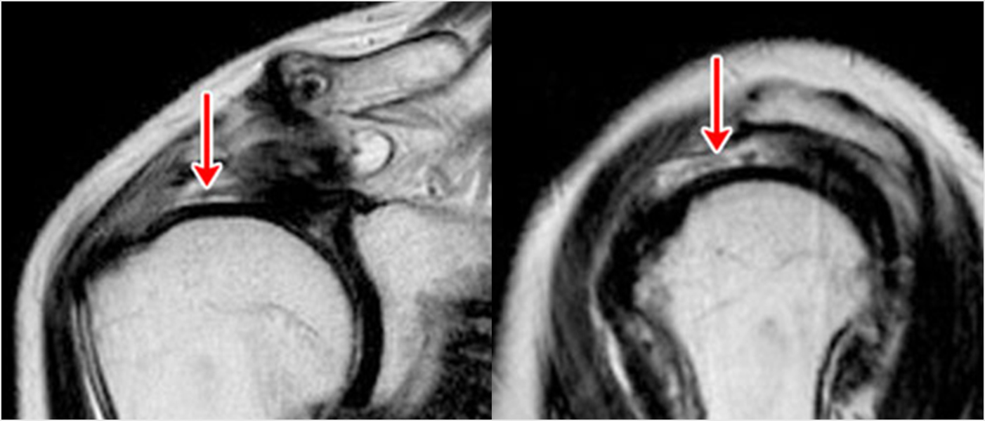 術前のMRI：矢印の白い部分が腱板断裂部分です