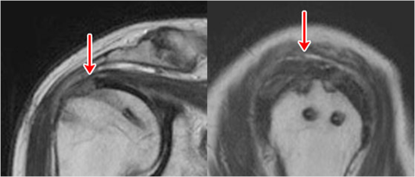 術後のMRI：腱が骨に癒合して白い部分（断裂部分）がなくなっています